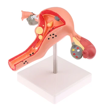 1 Adet Tıbbi Sahne Modeli Patolojik Rahim Yumurtalık Anatomik Modeli Anatomi Kesit Çalışma Aracı